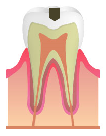 C1:エナメル質のむし歯