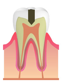 C2:象牙質のむし歯