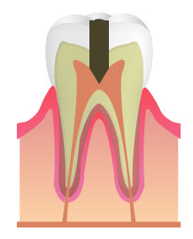 C3:神経まで達したむし歯